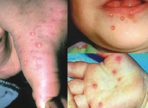 Bệnh tay chân miệng có nguy hiểm không? Cách phát hiện sớm điều trị kịp thời